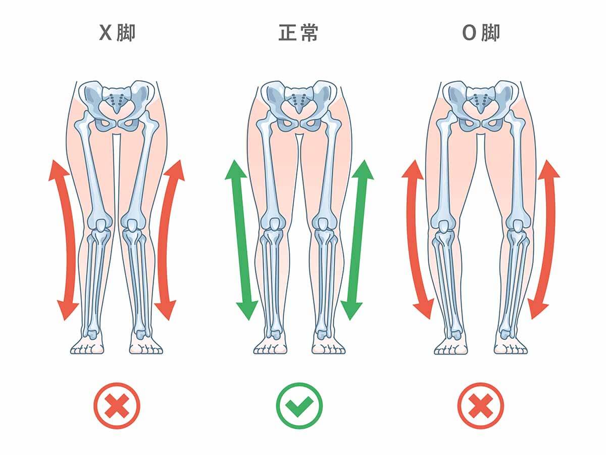 O脚とX脚の矯正