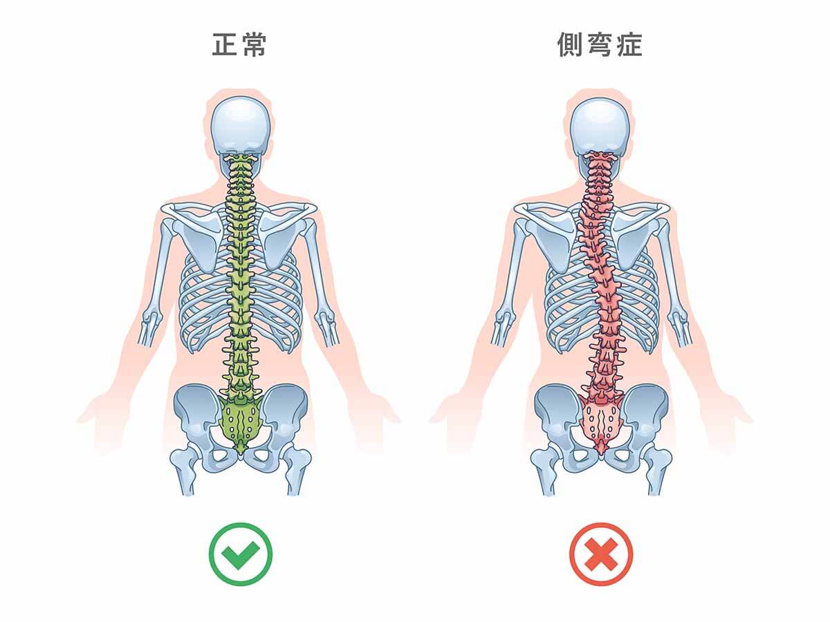 側弯症の脊椎