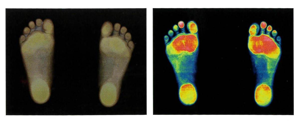 胼胝と足底筋膜炎の足型