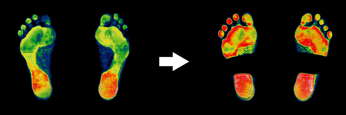 alleviating pressure and pain on the soles of the feet